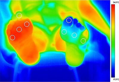Complicațiile diabetului