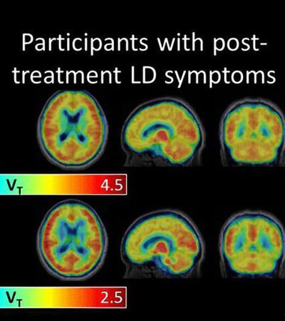 Boala Lyme (borelioză)