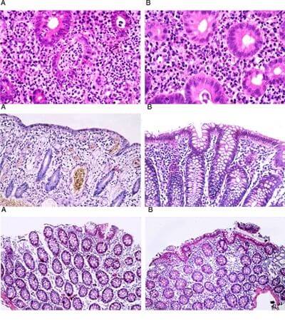 Boli inflamatorii intestinale